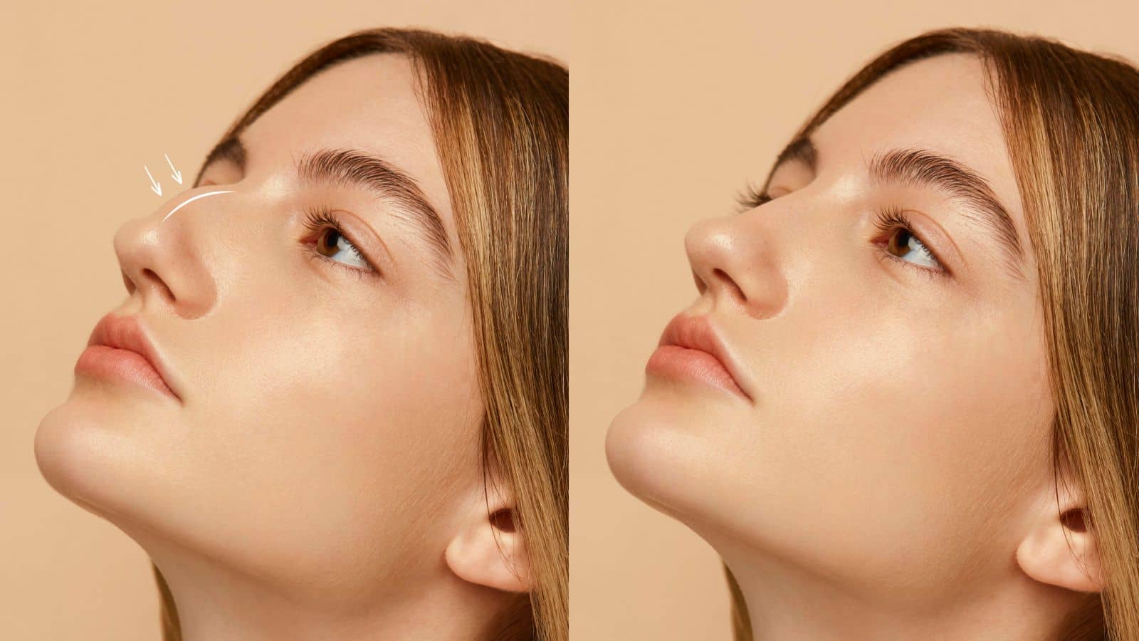 Rhinoplasty | FK Clinic