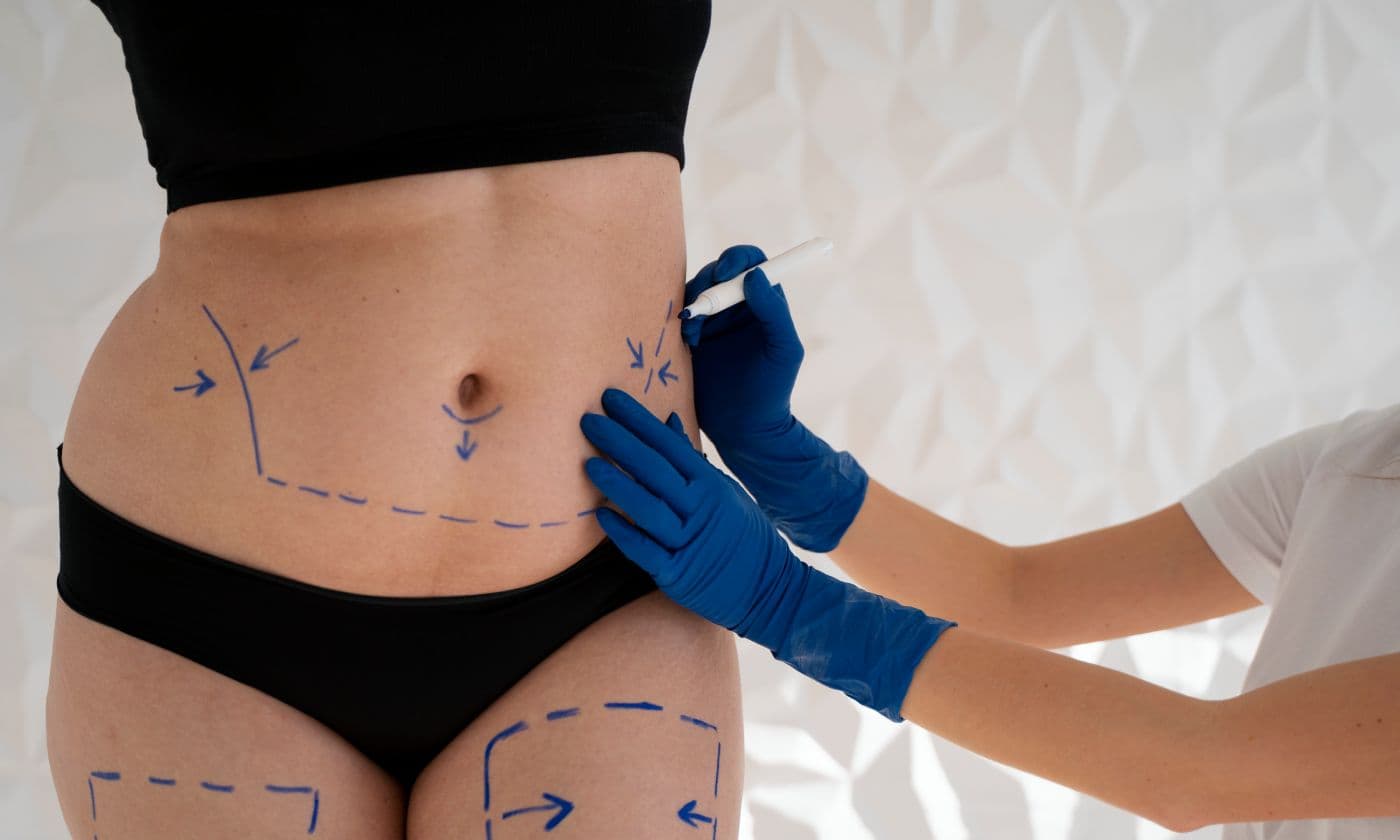 Aftercare tips following tummy tuck