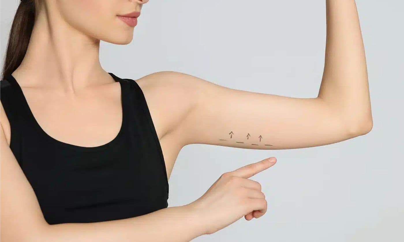 Aftercare tips after arm lift