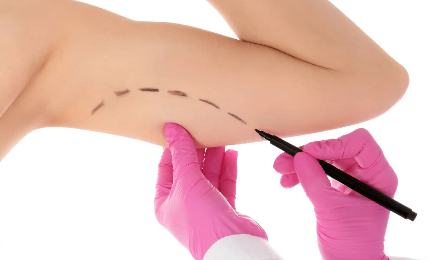 Who is a candidate for arm lift