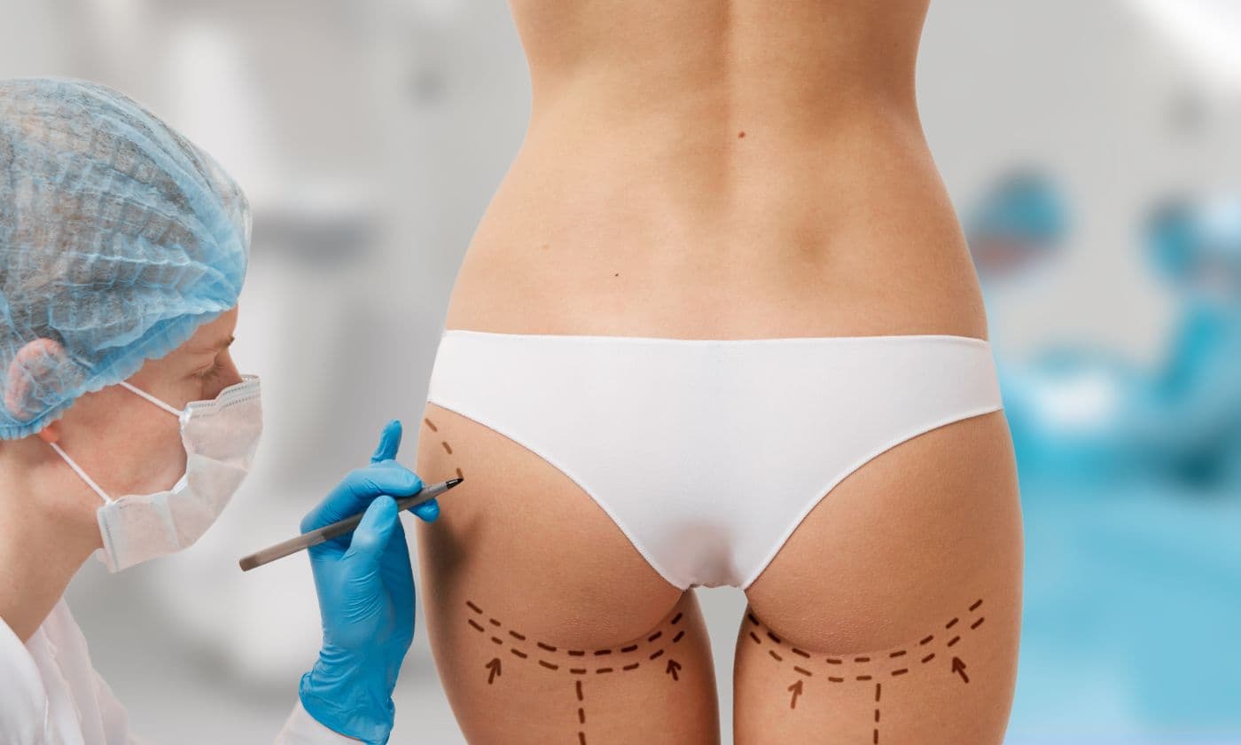 Who is a candidate for BBL fat transfer