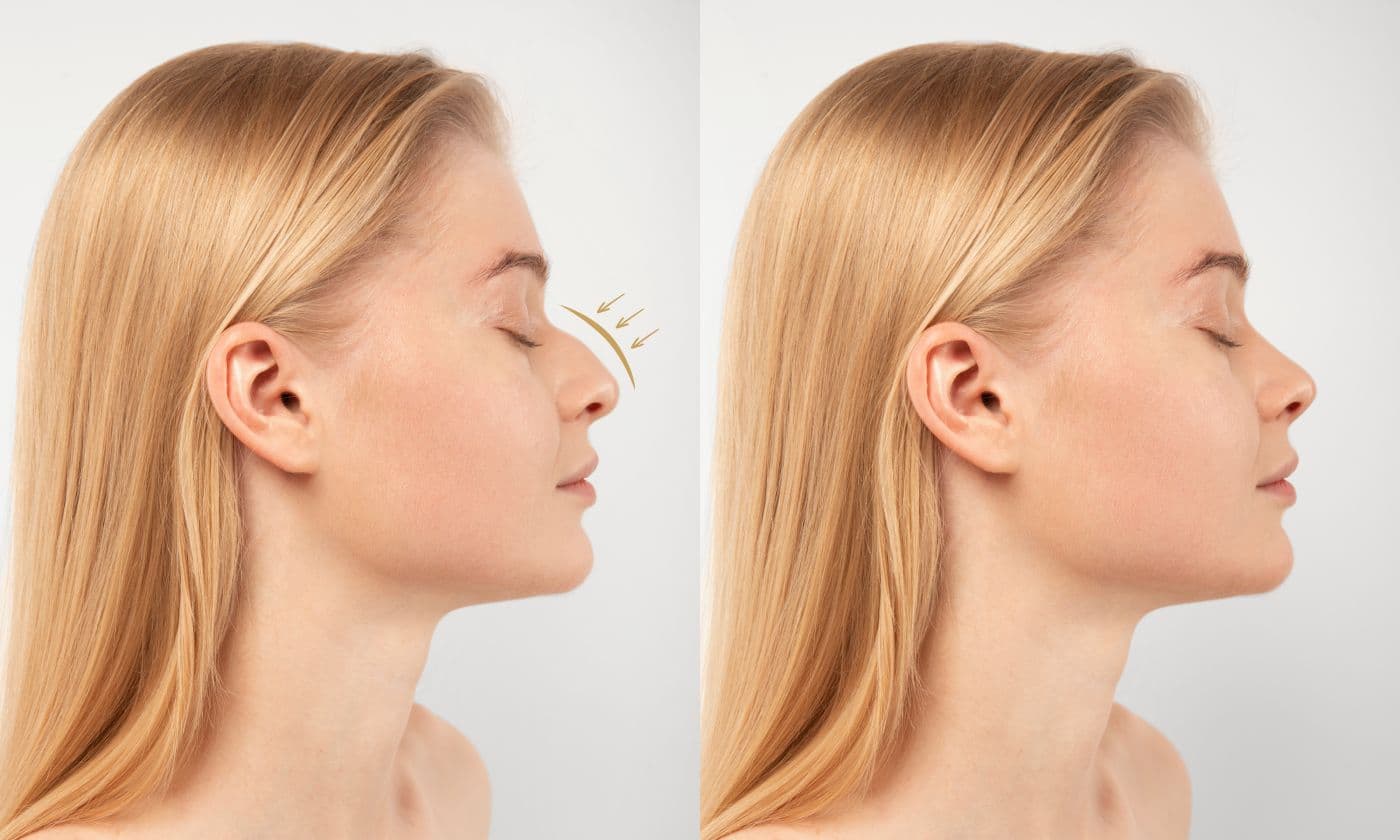 Who is a candidate for surgical rhinoplasty