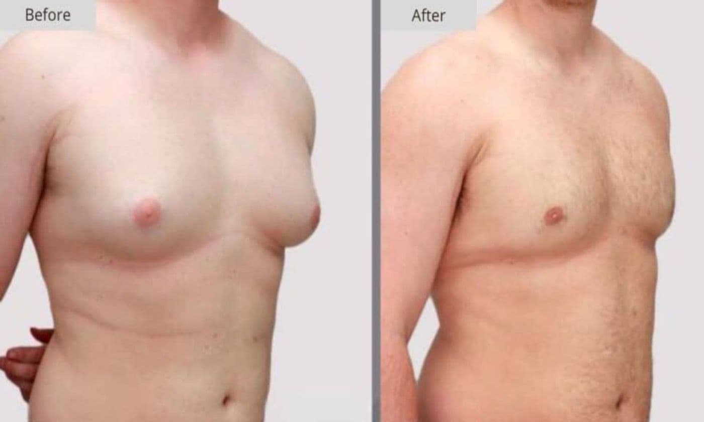 Who is a candidate for gynecomastia surgery