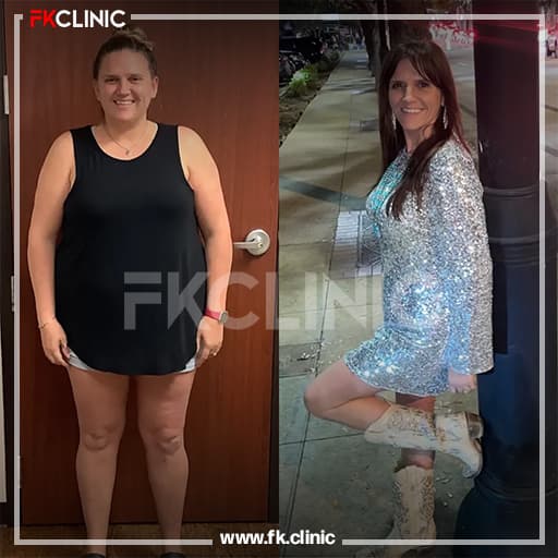 Gastric Balloon before/after result (after)