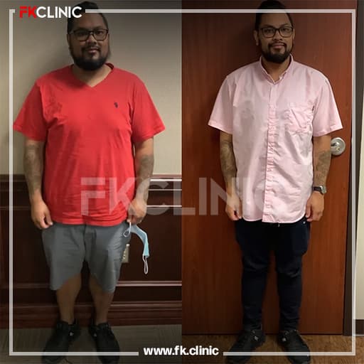 Gastric Sleeve before/after result (before)
