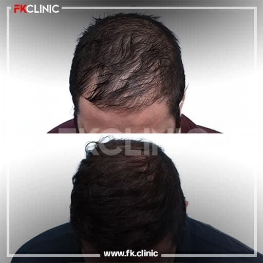 Before and after result for Hair Transplant (before)