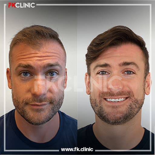 Before and after result for Hair Transplant (after)