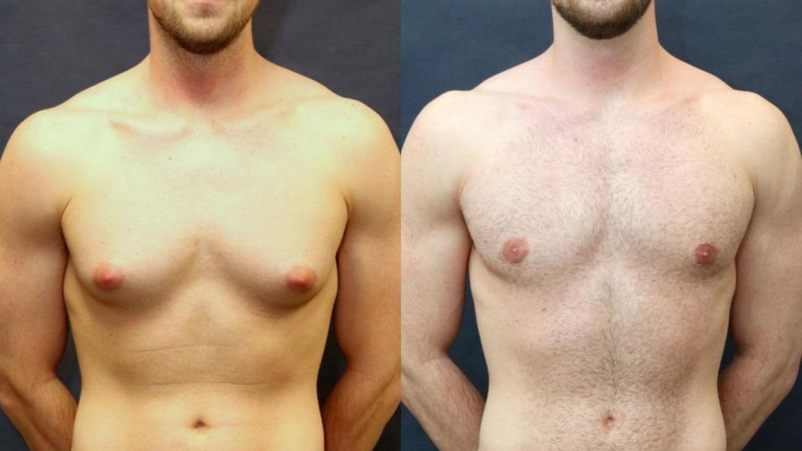 Gynecomastia – regain a flatter, more balanced chest with FK Clinic