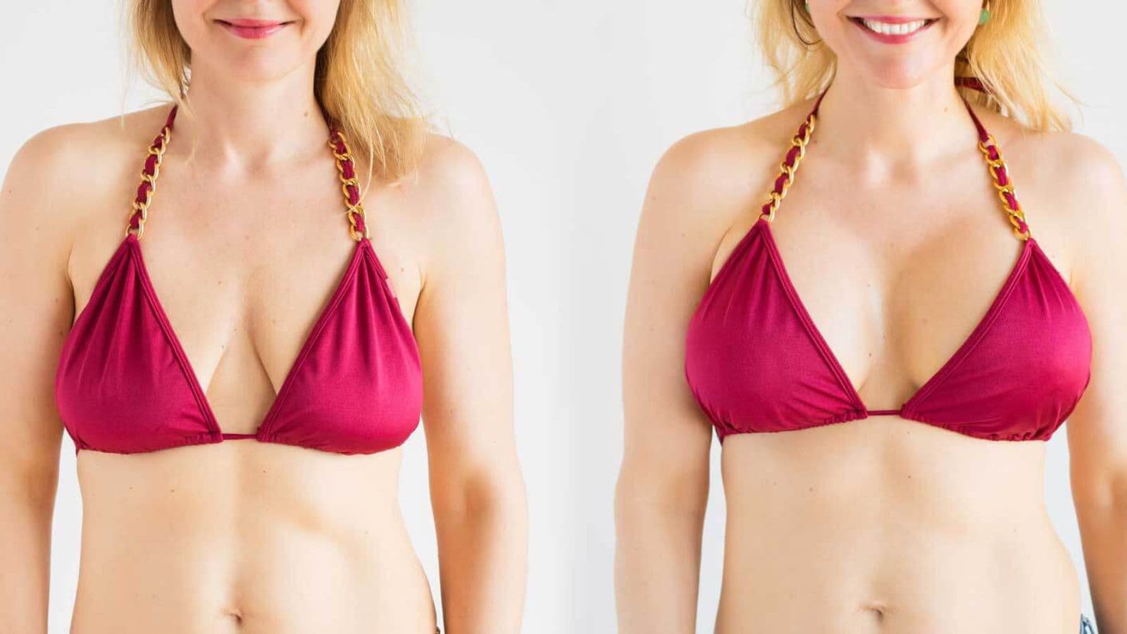 Breast lift at FK Clinic – safely restore lifted, natural shape