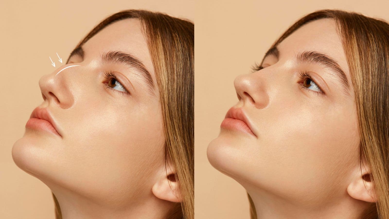 Surgical rhinoplasty – natural results in harmony with facial features