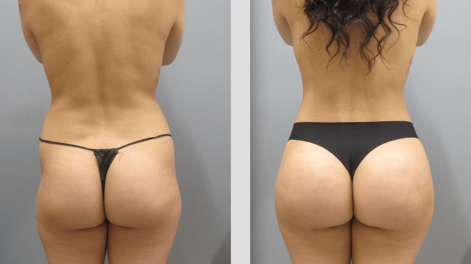 BBL fat transfer at FK Clinic – natural, attractive curves