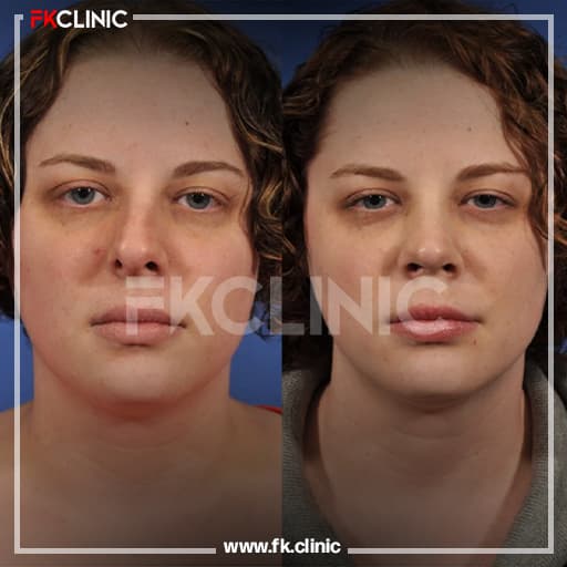 Rhinoplasty before/after result (after)