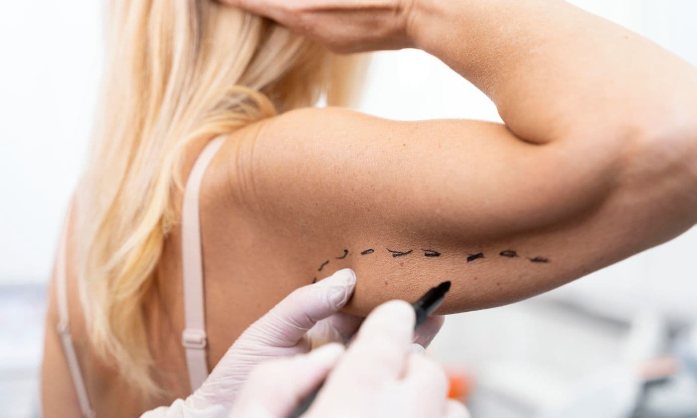 Arm lift steps at FK Clinic