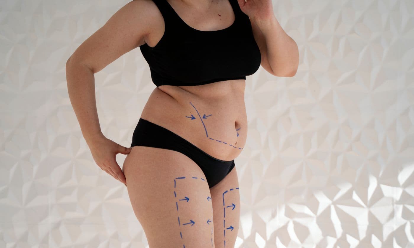 Tummy tuck steps at FK Clinic