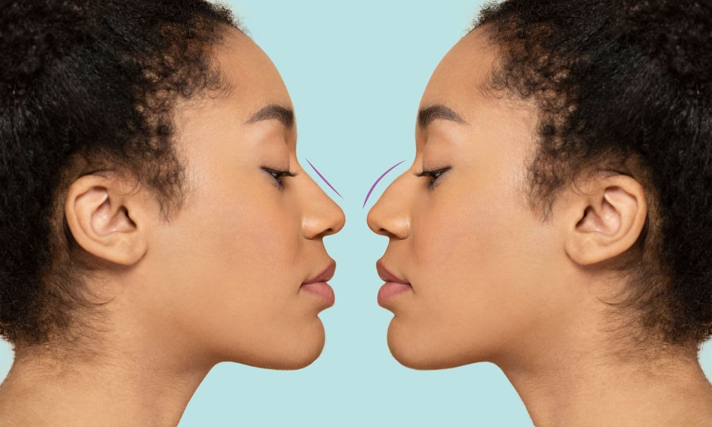 Rhinoplasty surgical steps at FK Clinic