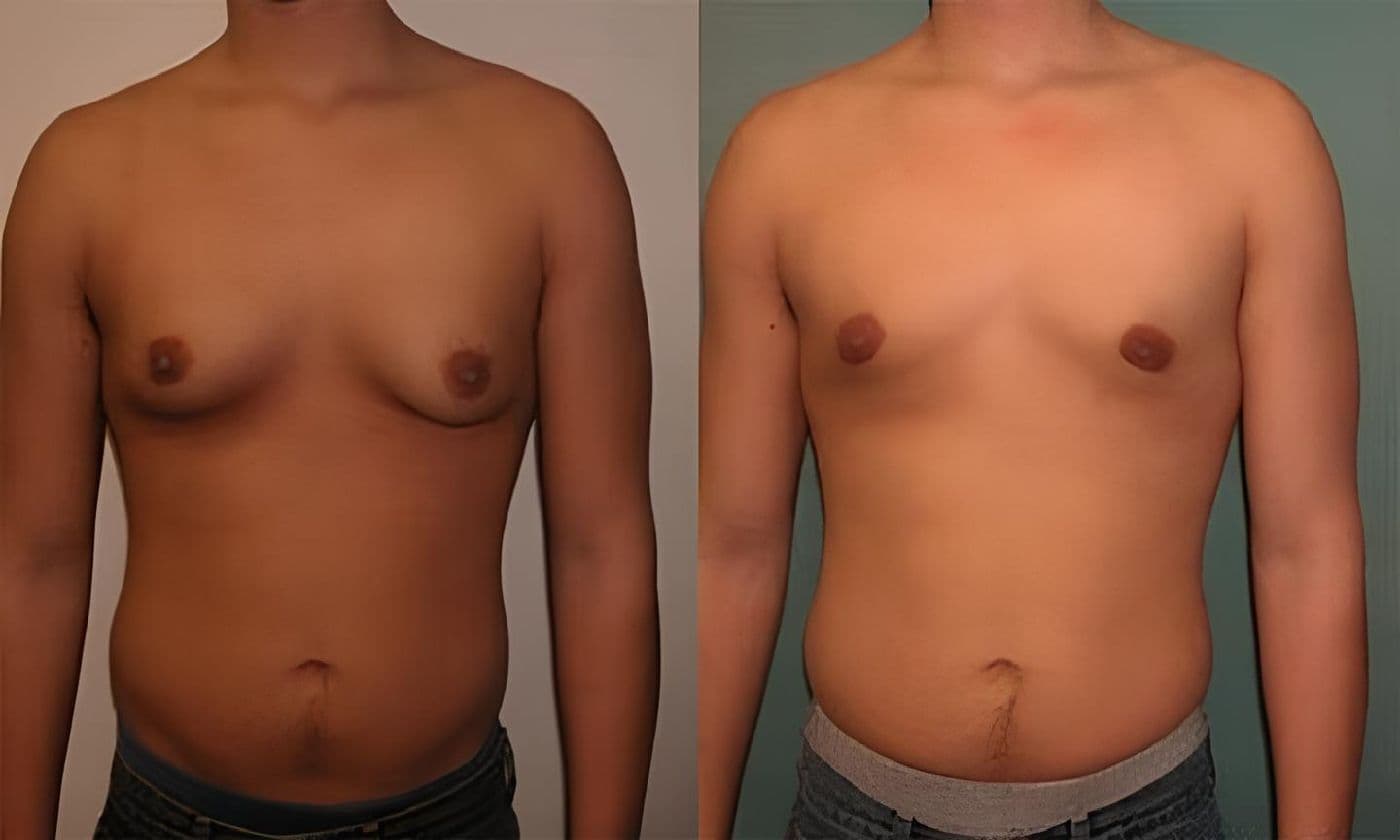 Gynecomastia surgery steps at FK Clinic
