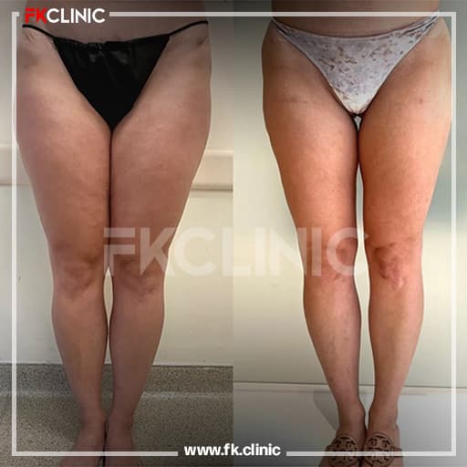 Before and after result for Thigh Lift (before)