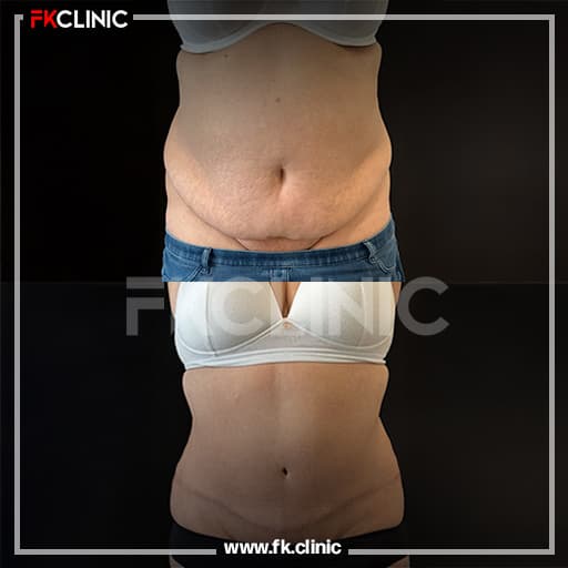 Before and after result for Tummy Tuck (before)