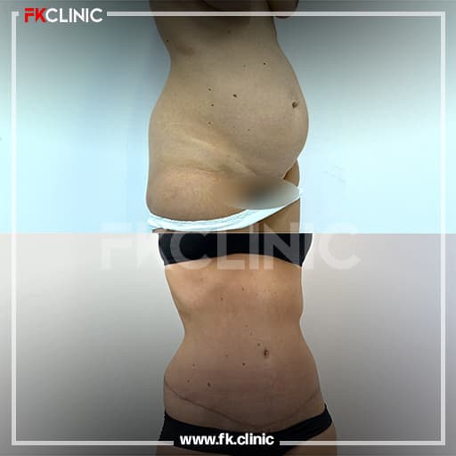 Before and after result for Tummy Tuck (after)