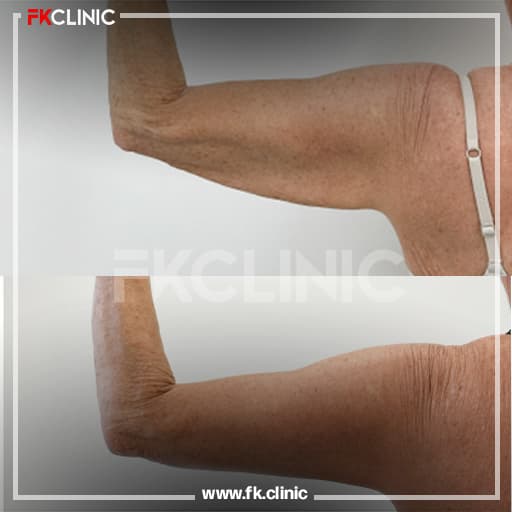 Before/after result for arm lift (before)