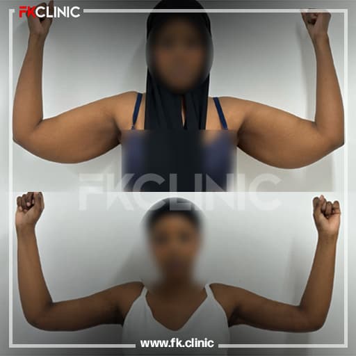 Before/after result for arm lift (after)