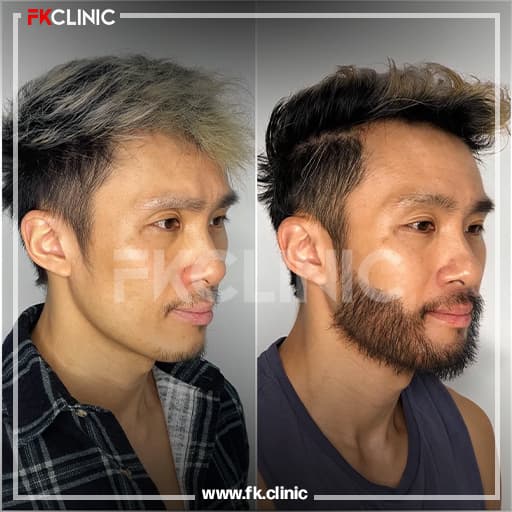 Beard transplant before/after result (before)