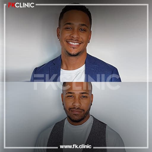 Beard transplant before/after result (after)