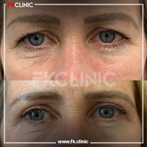 Eyelid blepharoplasty before/after result (before)