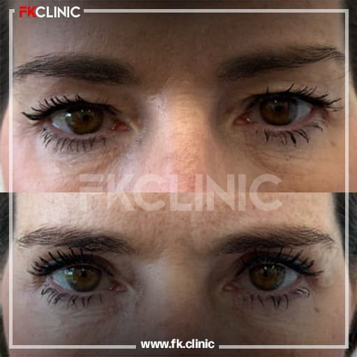 Eyelid blepharoplasty before/after result (after)