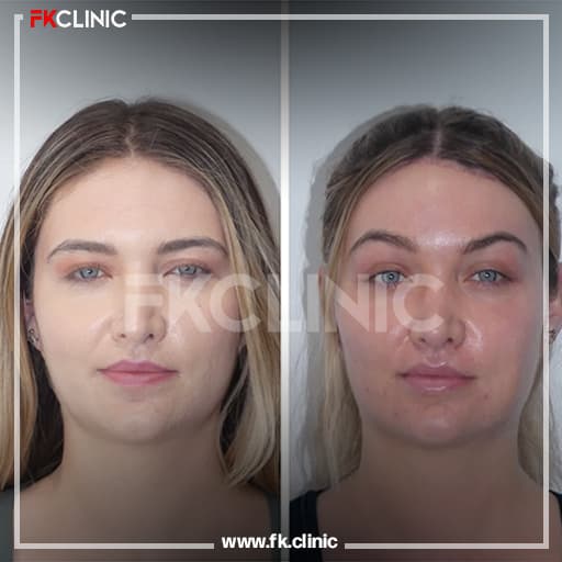 Brow lift before/after result (before)