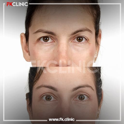 Brow lift before/after result (after)
