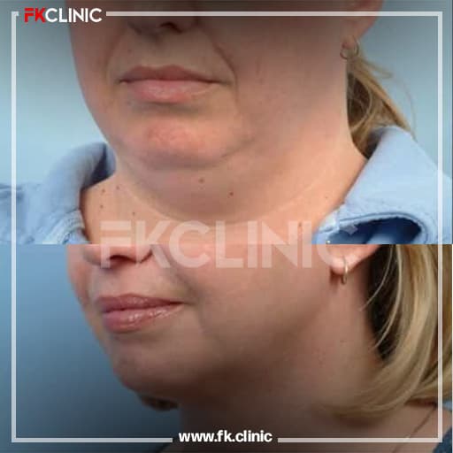 Double chin removal before/after result (before)