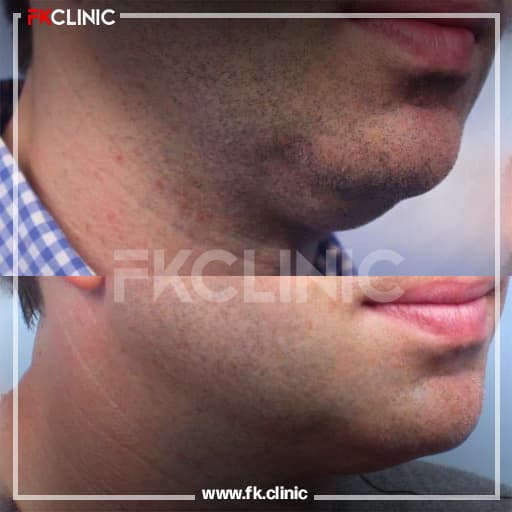 Double chin removal before/after result (after)
