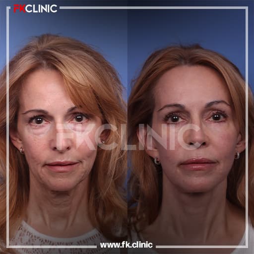 Face lift before/after result (before)