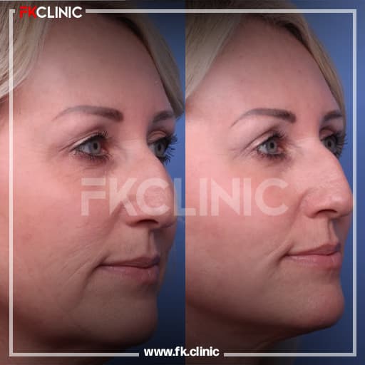 Face lift before/after result (after)