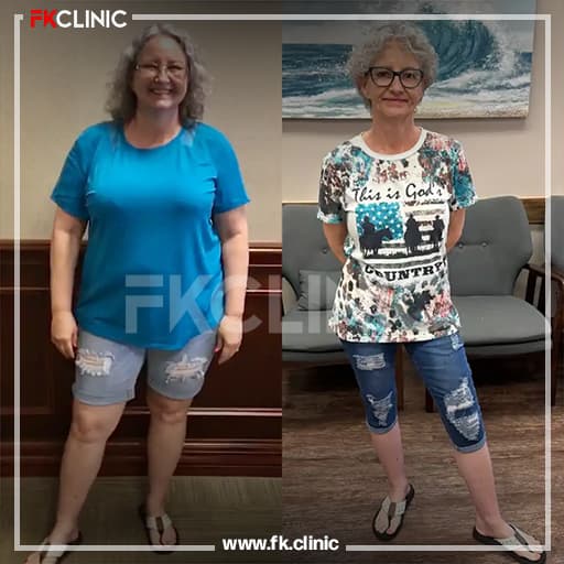 Gastric Balloon before/after result (before)