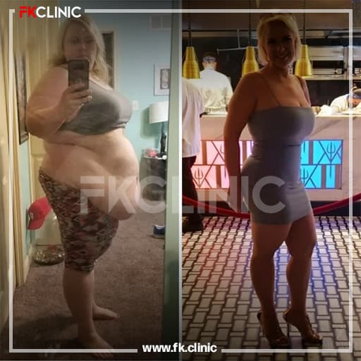Gastric Bypass before/after result (before)
