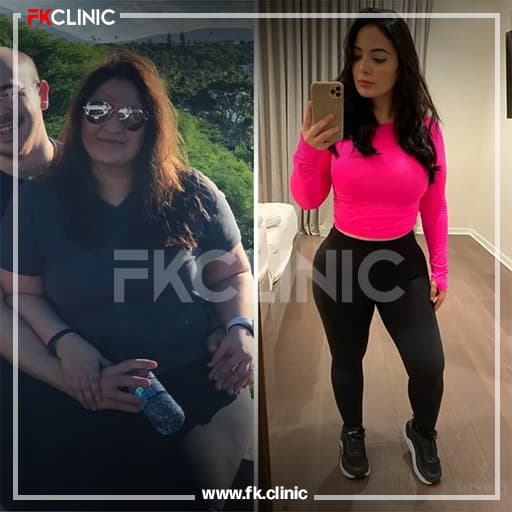 Gastric Bypass before/after result (after)