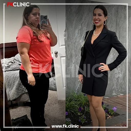 Gastric Sleeve before/after result (after)