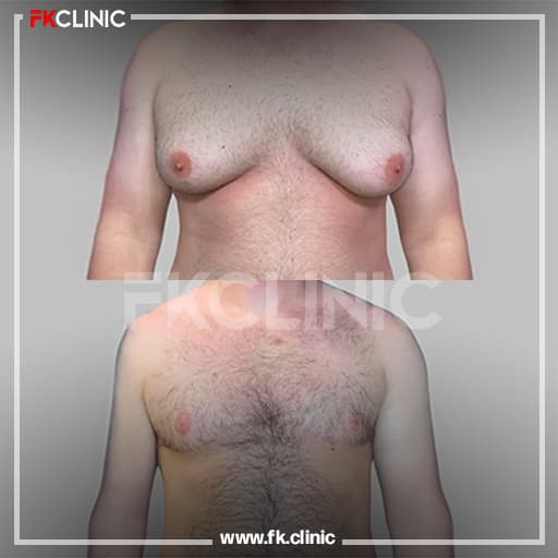 Before and after result for Gynecomastia (after)