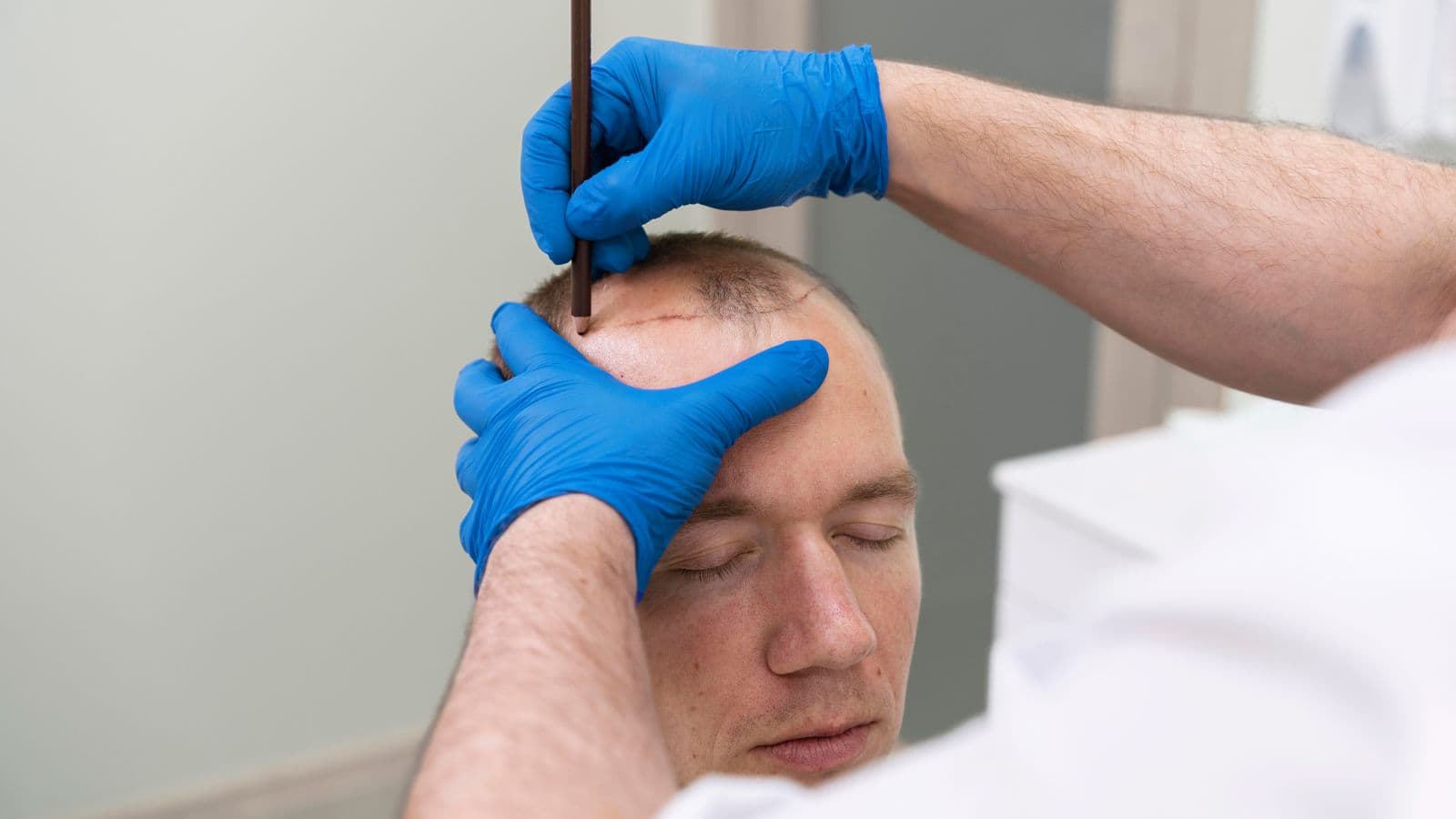 Hair Transplant | FK Clinic