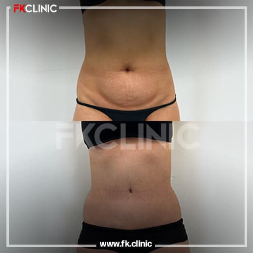 Before and after result for Liposuction (before)