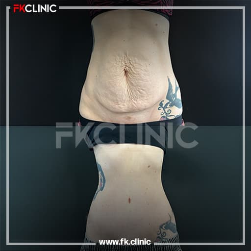 Before and after result for Liposuction (after)