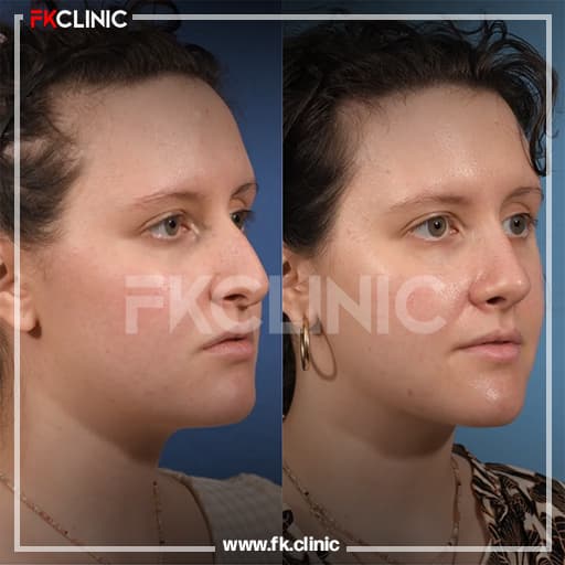 Rhinoplasty before/after result (before)