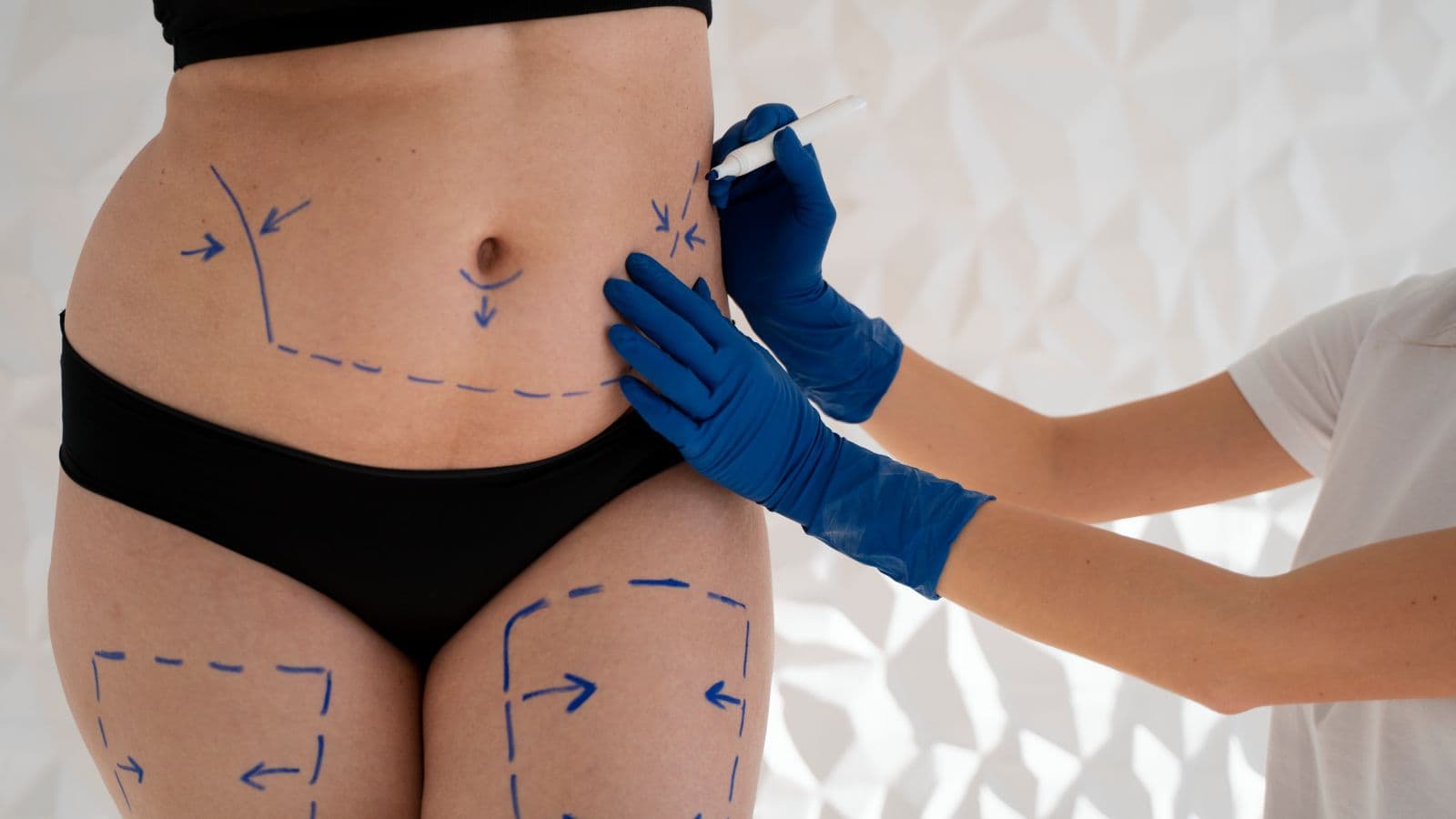 Tummy Tuck | FK Clinic